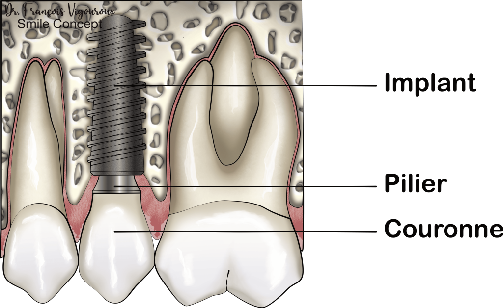 illustration implant dentaire 3