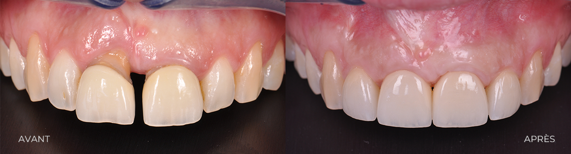 CAS 6 IMPLANTO